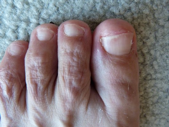 Nail fungus treatment over the counter