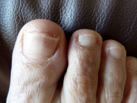 everything-you-need-to-know-about-laser-treatment-for-toenail-fungus